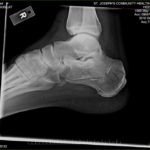 heel-fracture