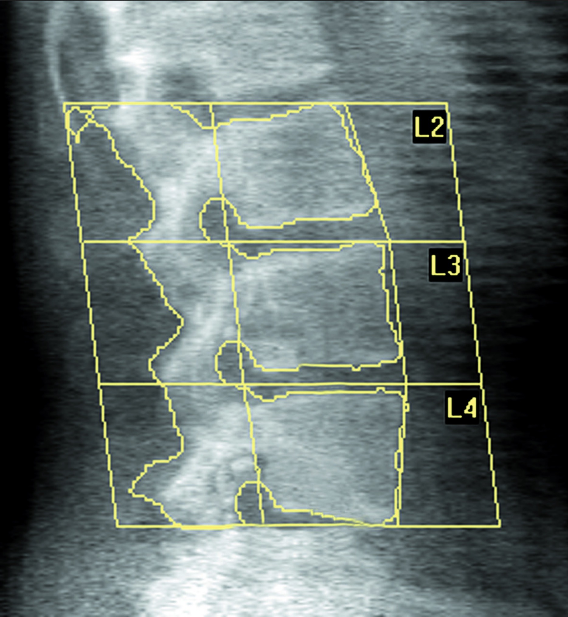 Supine-Lateral-BMD