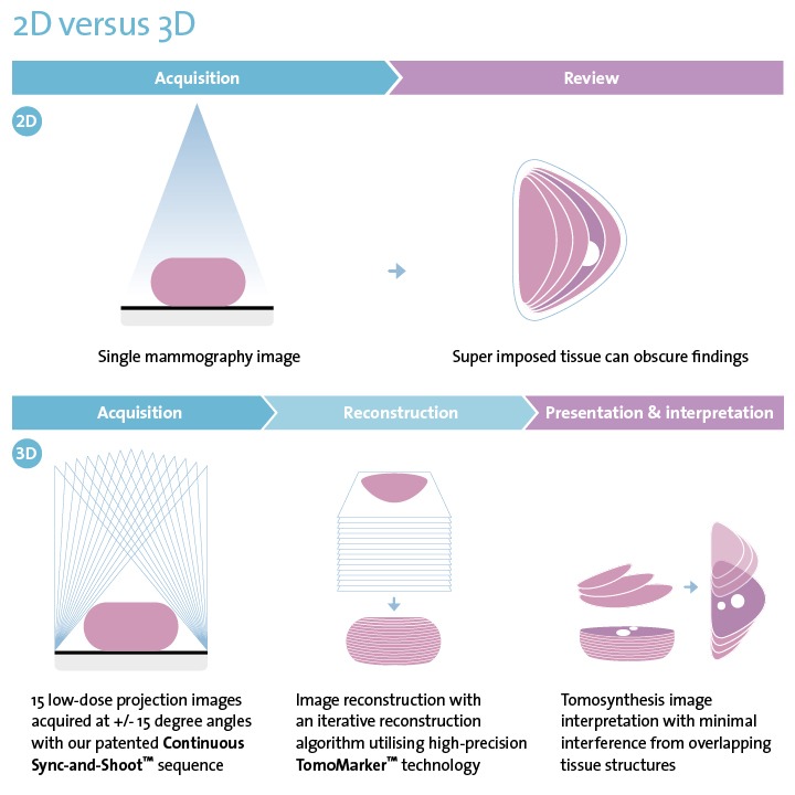planmed_clarity_3d_digital_breast_tomosynthesis