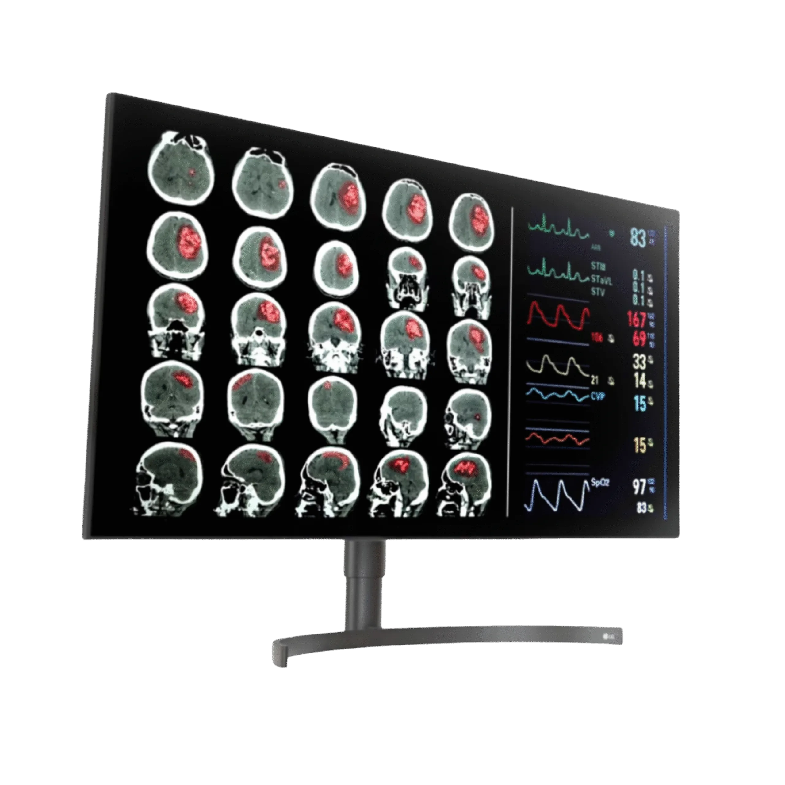LG 32HL512D 31.5-inch 8MP Nano IPS Diagnostic Monitor
