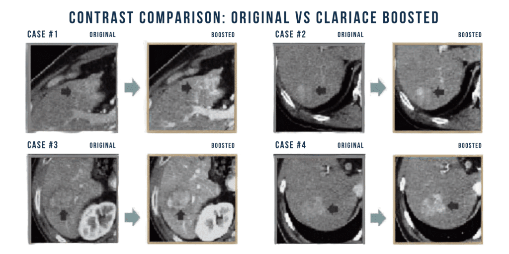 ClariACE-2