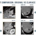 ClariACE-2