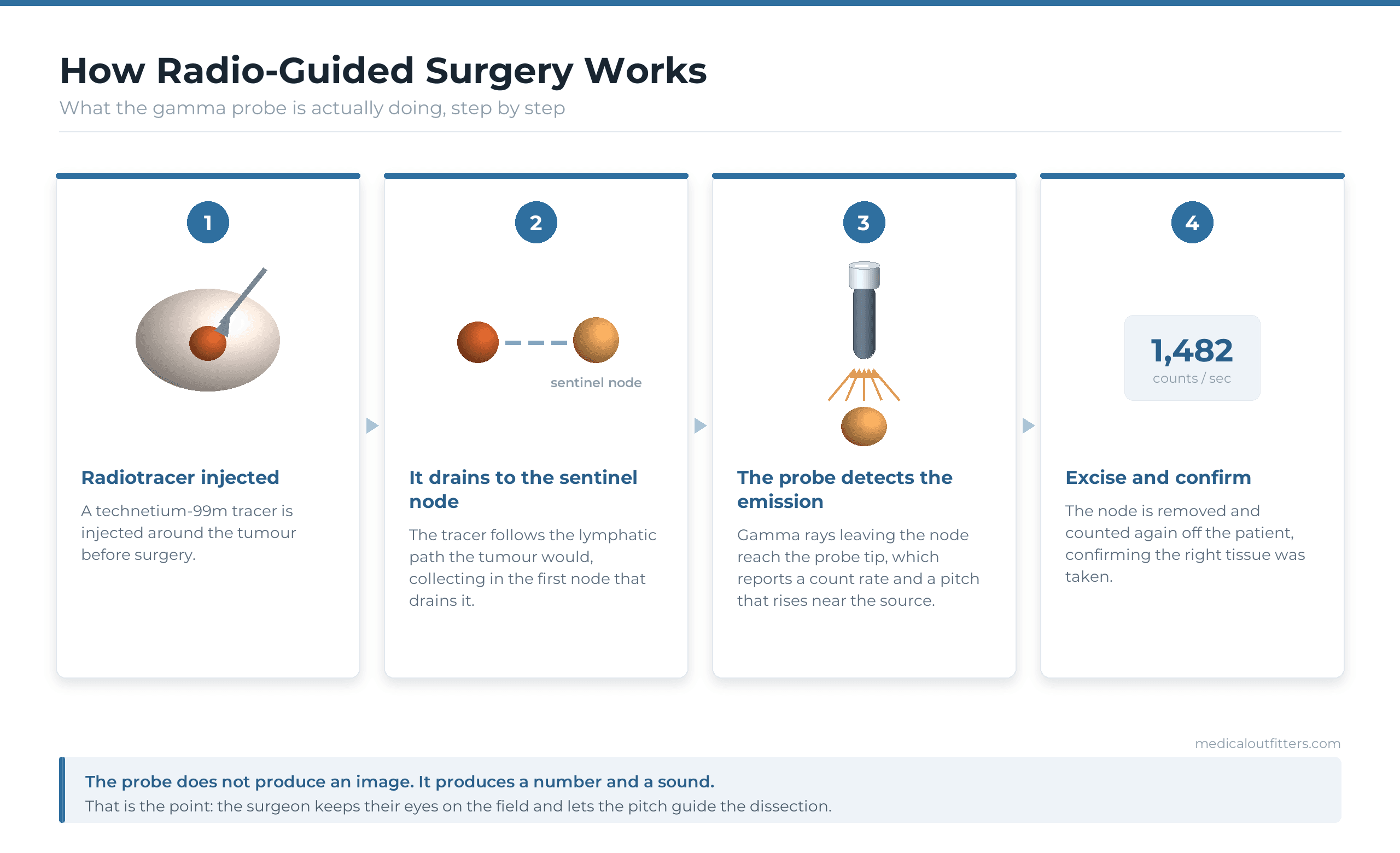 Diagram showing the four steps of radio-guided surgery: radiotracer injection, drainage to the sentinel lymph node, gamma probe localisation and ex vivo confirmation